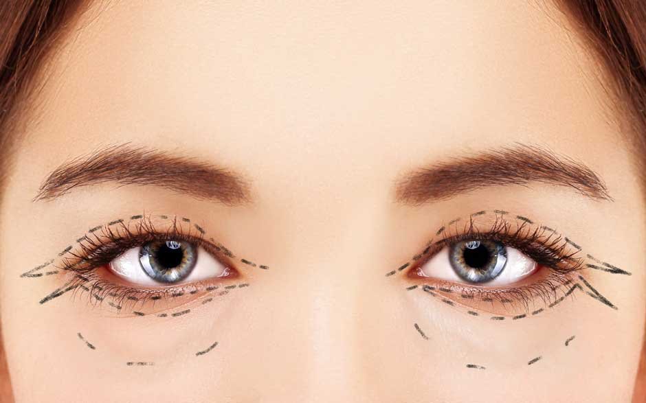Long Will Your Eyelid Surgery Results Last